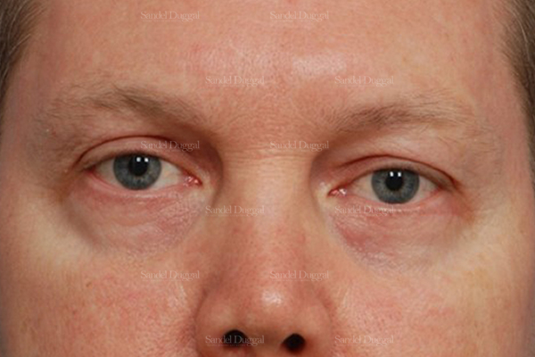 eyelid rejuvenation patient