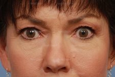 eyelid rejuvenation patient