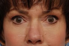 eyelid rejuvenation patient