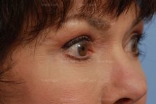 eyelid rejuvenation patient