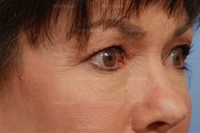 eyelid rejuvenation patient