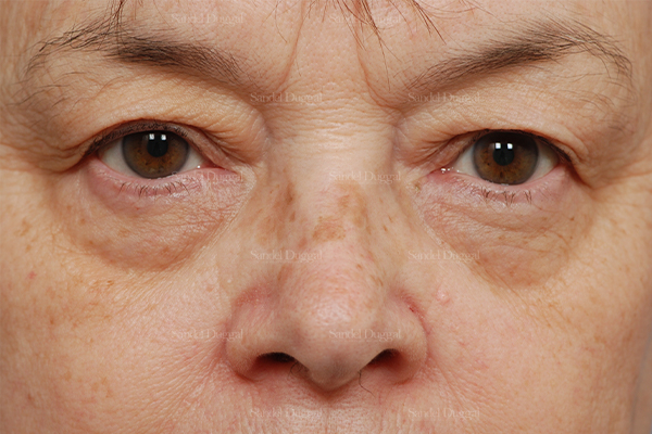 eyelid rejuvenation patient