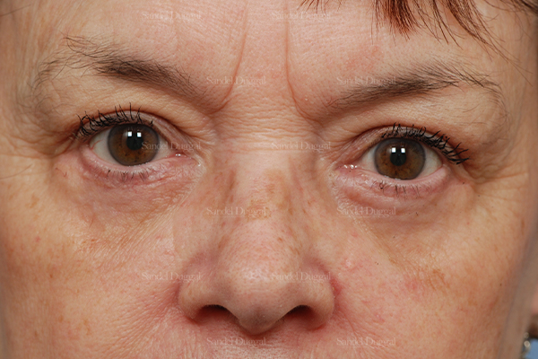 eyelid rejuvenation patient