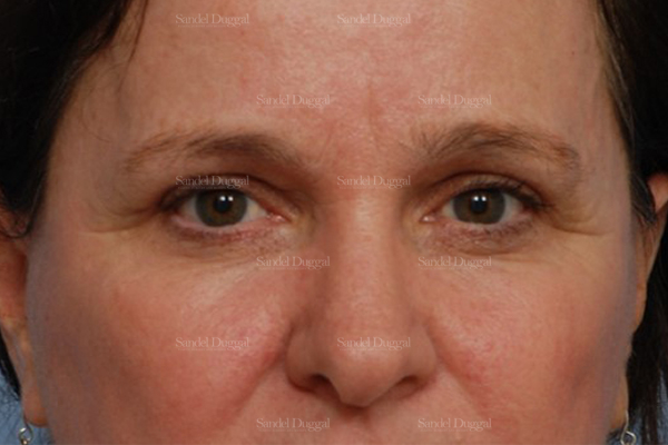 eyelid rejuvenation patient