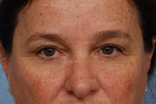 eyelid rejuvenation patient