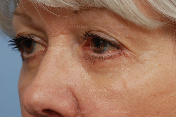 eyelid rejuvenation patient