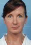 facelift patient
