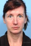 facelift patient