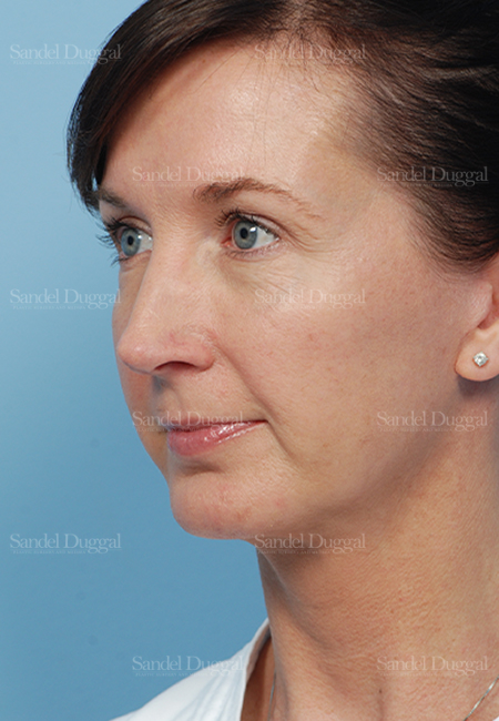 facelift patient