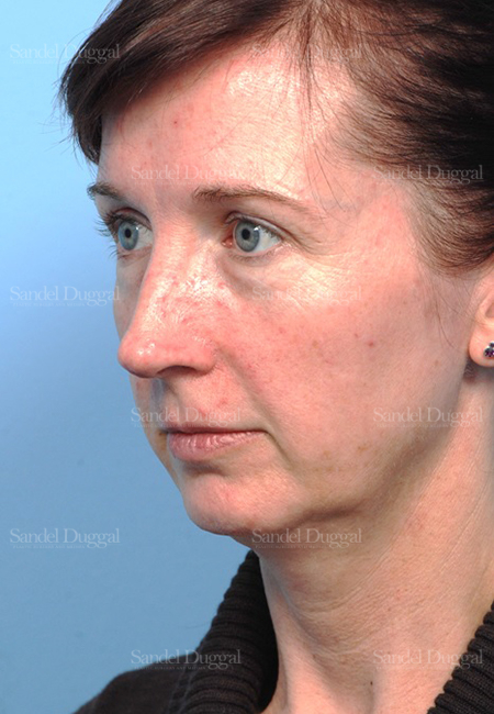 facelift patient