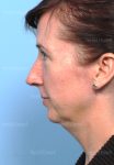 facelift patient