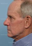 facelift patient