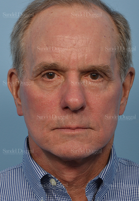 facelift patient