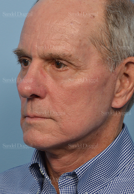 facelift patient