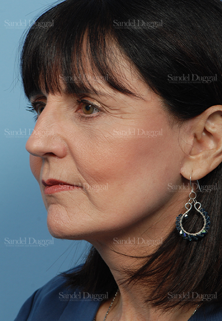 facelift patient