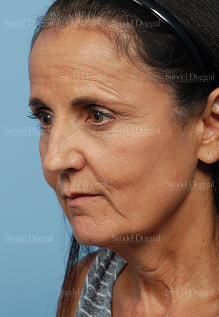 facelift patient