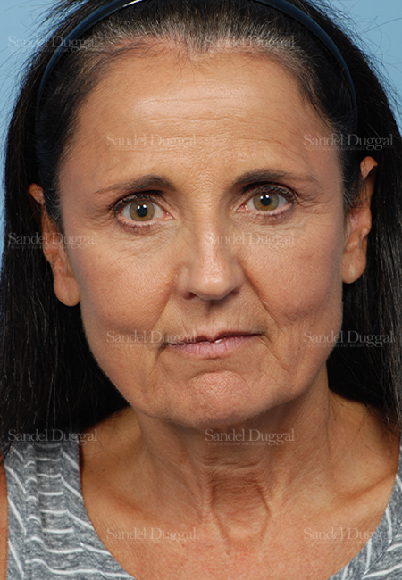 facelift patient
