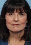 facelift patient