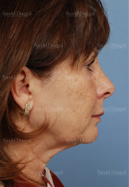 facelift patient