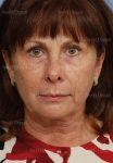 facelift patient