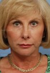 facelift patient