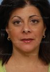 facelift patient