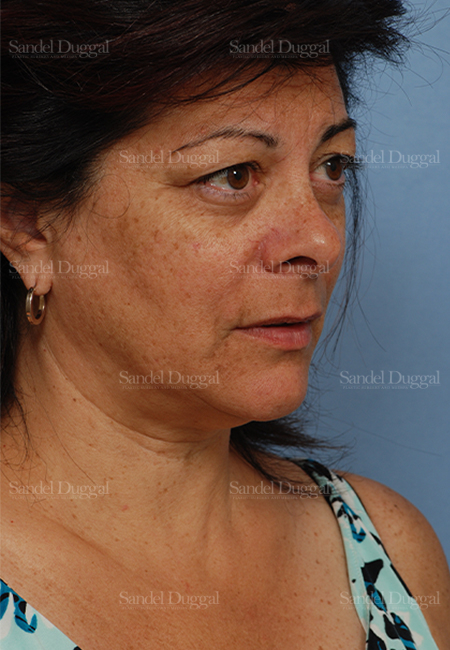 facelift patient