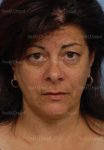 facelift patient