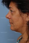 facelift patient
