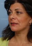 facelift patient