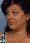 facelift patient