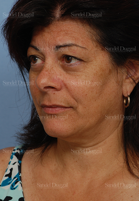facelift patient
