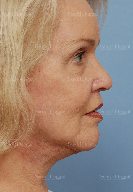 facelift patient