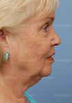 facelift patient