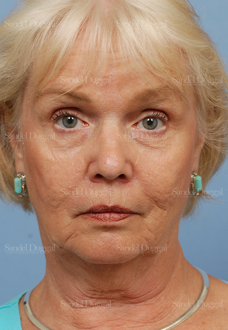 facelift patient