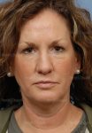 facelift patient