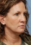 facelift patient