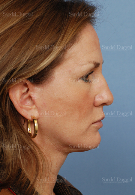 facelift patient