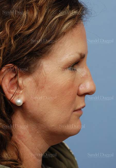 facelift patient
