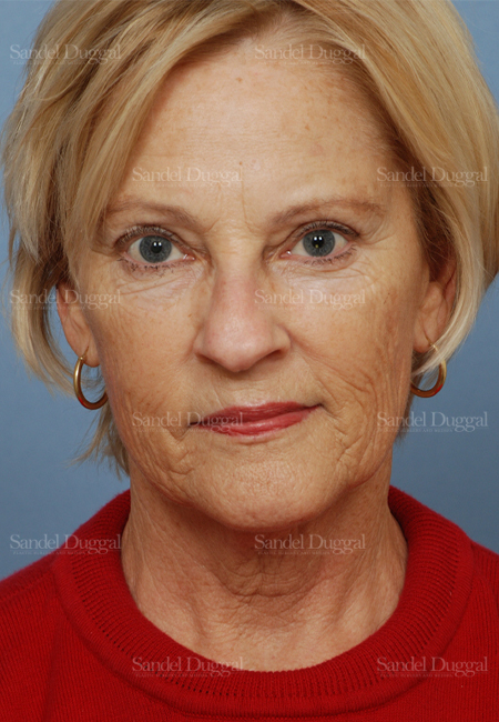 facelift patient