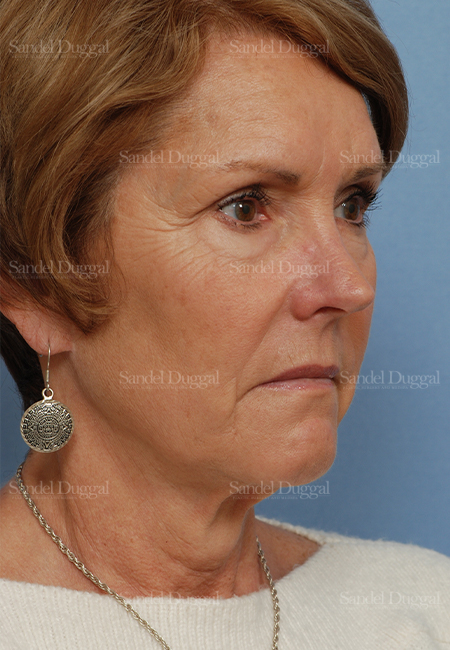 facelift patient