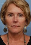 facelift patient