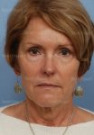 facelift patient