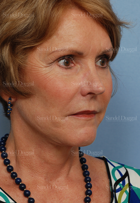 facelift patient