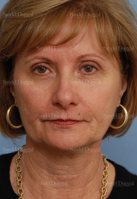facelift patient
