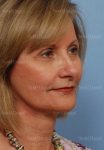facelift patient