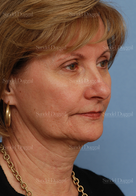 facelift patient