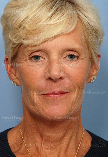 facelift patient