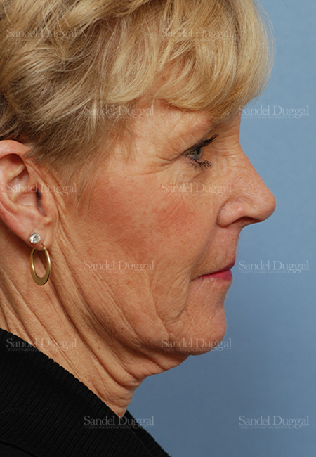 facelift patient
