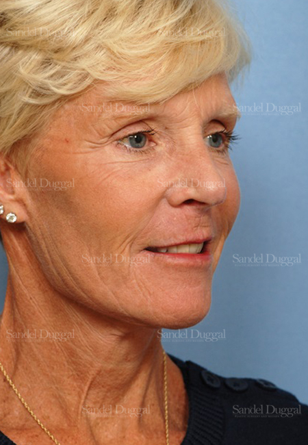 facelift patient